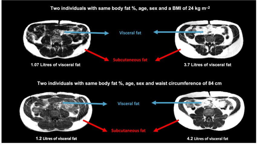 Visceral fat MRI comparison showing dangerous internal fat accumulation